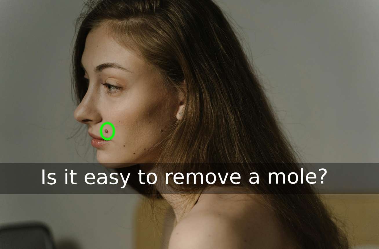 IT IS EASY TO REMOVE A MOLE 